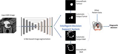 Fully automated bladder tumor segmentation from T2 MRI images using 3D U-Net algorithm